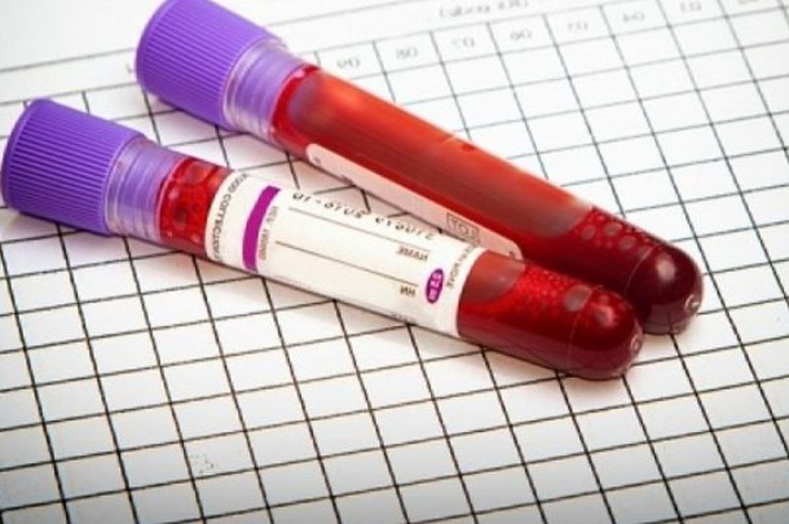 Ερευνα: Το εύρος κατανομής των ερυθρών στο αίμα αποτελεί δείκτη αυξημένου κινδύνου θανάτου από κορωνοϊό | ενότητες, υγεία | Real.gr