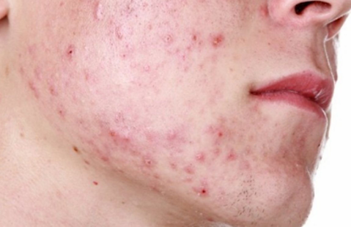 Θεραπεία για τη χειρότερη ακμή