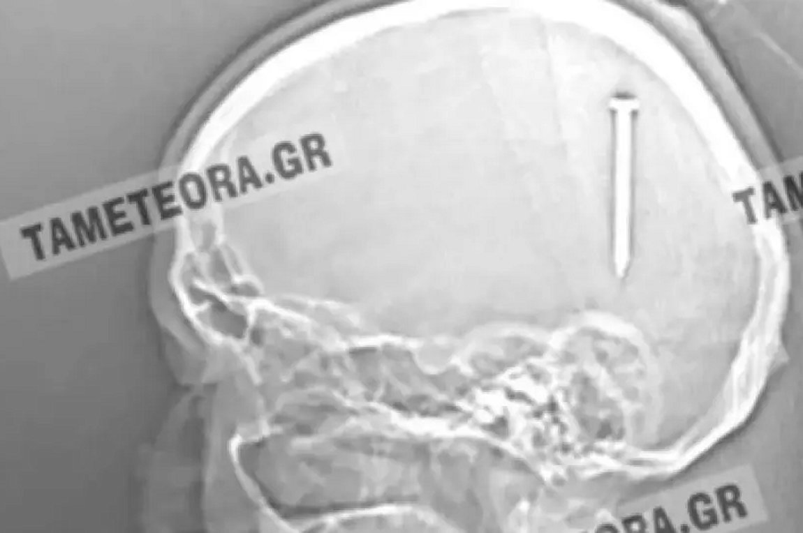 Καλαμπάκα: Καρφί 5 εκατοστών σφηνώθηκε στο κεφάλι άνδρα