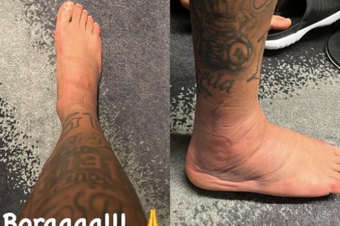 Επιμένει ο… αστράγαλος του Νεϊμάρ