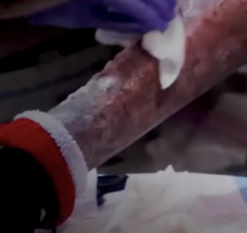 ΗΠΑ: Tranq- Το ναρκωτικό των «ζόμπι» με τις τρομακτικές συνέπειες