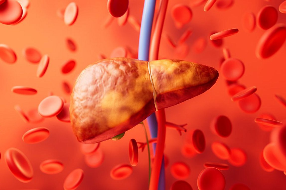 Πρώιμη κίρρωση του ήπατος: Αυτά τα συμπτώματα δεν πρέπει ποτέ να αγνοήσετε