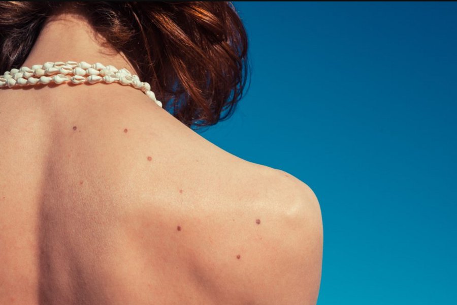 Καρκίνος του δέρματος: Το επίθεμα που μπορεί να τον ανιχνεύσει έγκαιρα