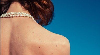 Καρκίνος του δέρματος: Το επίθεμα που μπορεί να τον ανιχνεύσει έγκαιρα