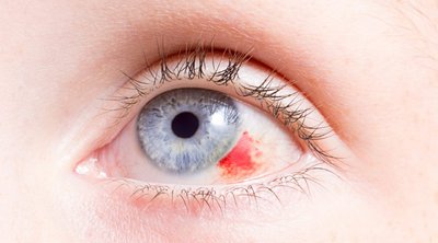 Έχετε σπασμένο αγγείο στο μάτι; Πώς να το αντιμετωπίσετε μόνοι σας στο σπίτι