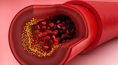Χοληστερόλη: Ο τύπος των λιπιδίων που μπορεί να προκαλέσει καρδιακή προσβολή – Δεν φαίνεται στις εξετάσεις