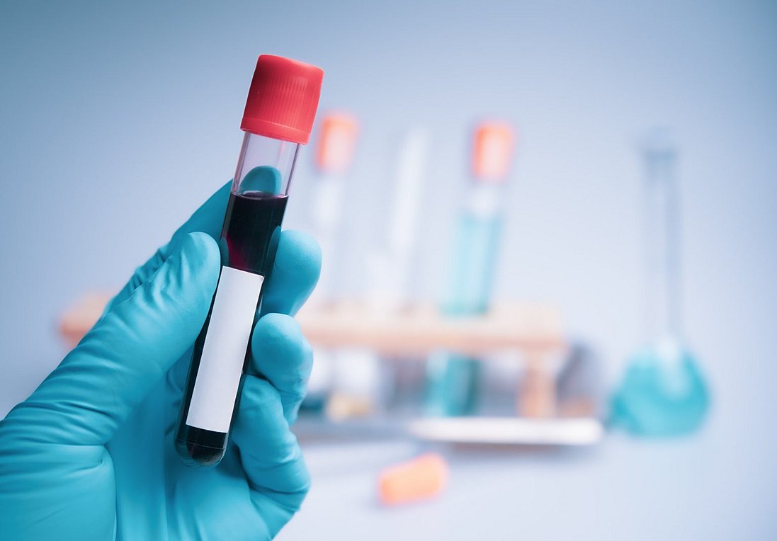 Καρκίνος παχέος εντέρου: Νέα εξέταση αίματος τον εντοπίζει έγκαιρα