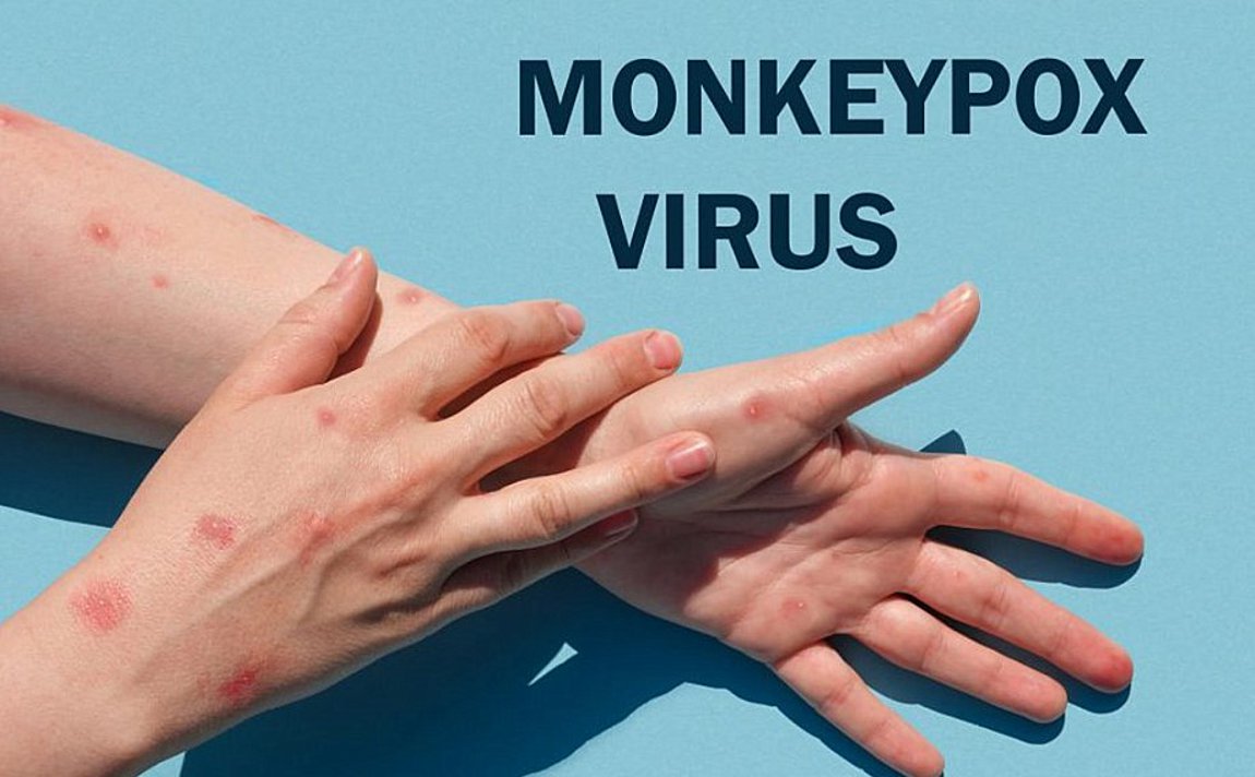 Ευλογιά των πιθήκων: Πώς μεταδίδεται και ποια είναι τα συμπτώματα