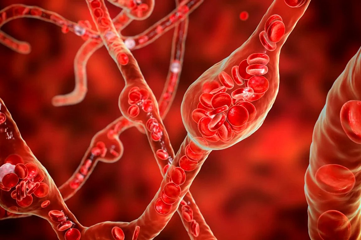 Ανεύρυσμα αορτής: Τα συμπτώματα που πρέπει να γνωρίζετε – Πώς να μειώσετε τον κίνδυνο