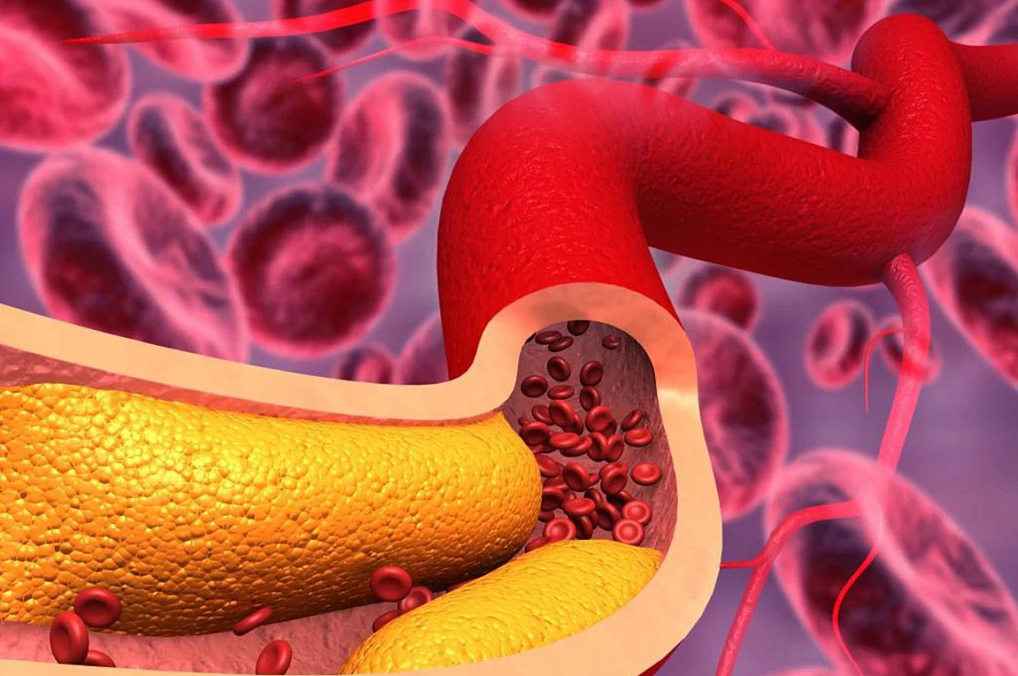 Αθηροσκλήρωση: Νέα θεραπεία με νανοσωματίδια μειώνει τη συσσώρευση πλάκας στις αρτηρίες