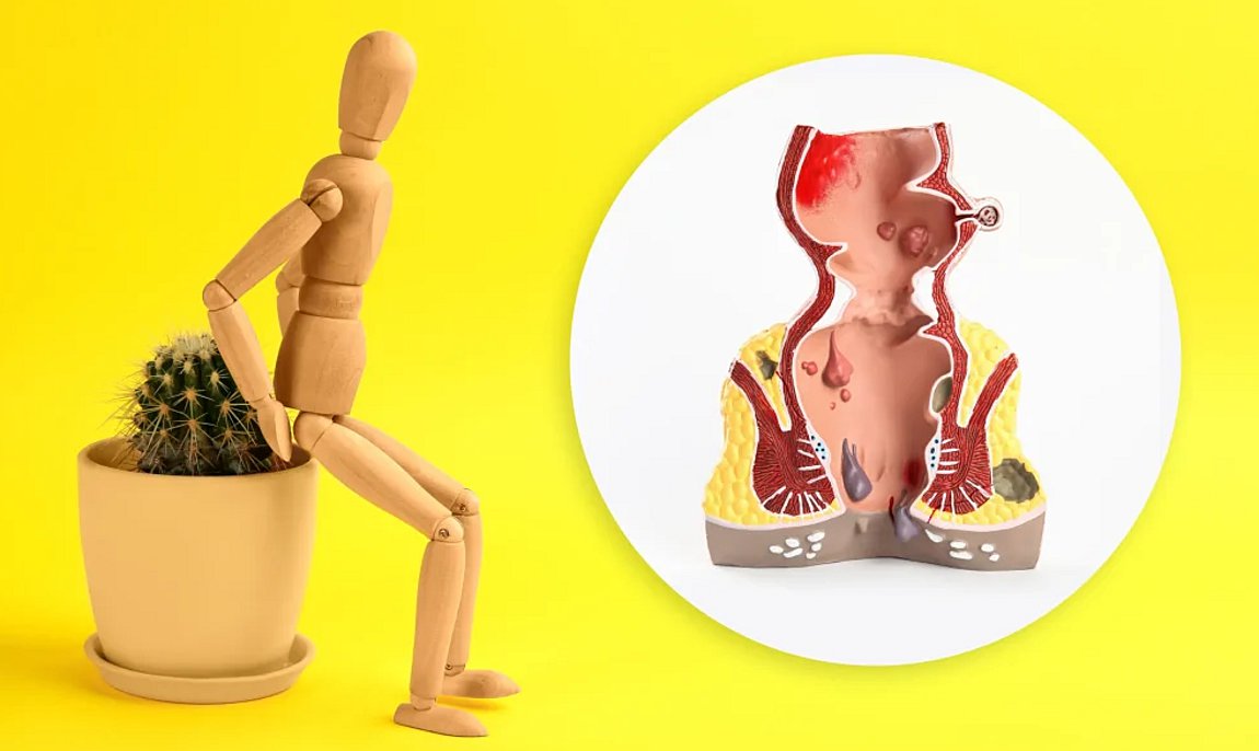 Αιμορροΐδες: Πώς φεύγουν με φυσικό τρόπο- Η καλύτερη αντιμετώπιση στο σπίτι