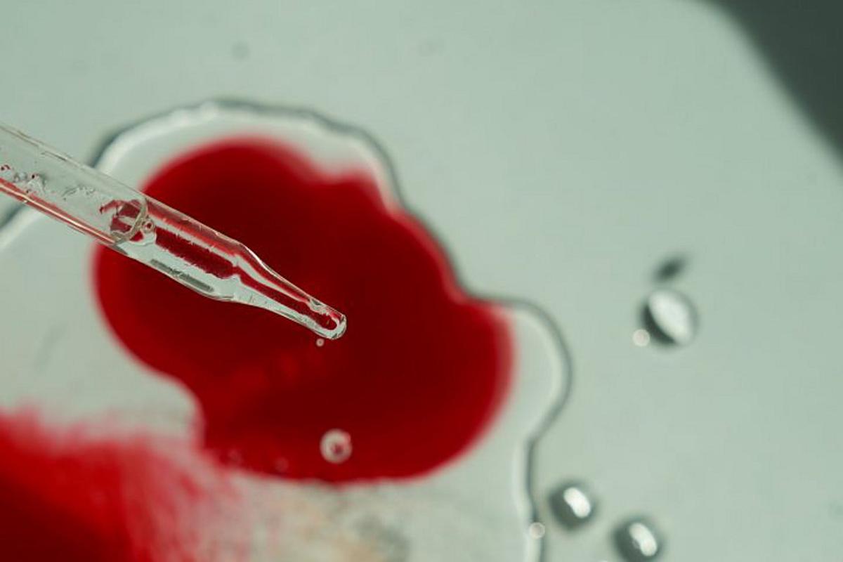 Καρκίνος του παγκρέατος: Πρωτοποριακή εξέταση αίματος τον εντοπίζει με ακρίβεια 85%